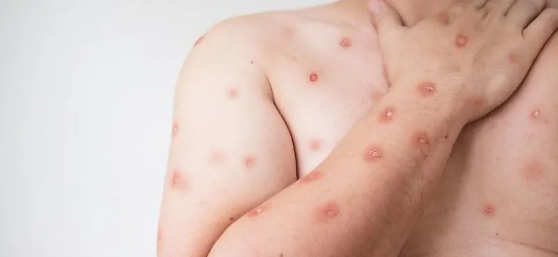 Nova variante da Mpox acende sinal de alerta em Mato Grosso