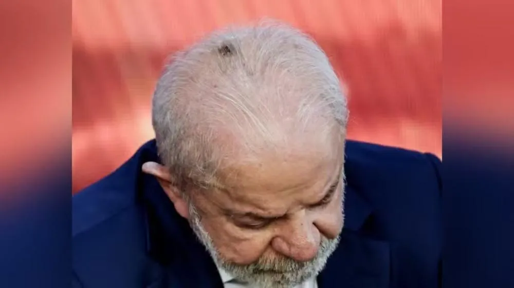 Lula tira lesão de câncer de pele no couro cabeludo e volta para casa após alta médica